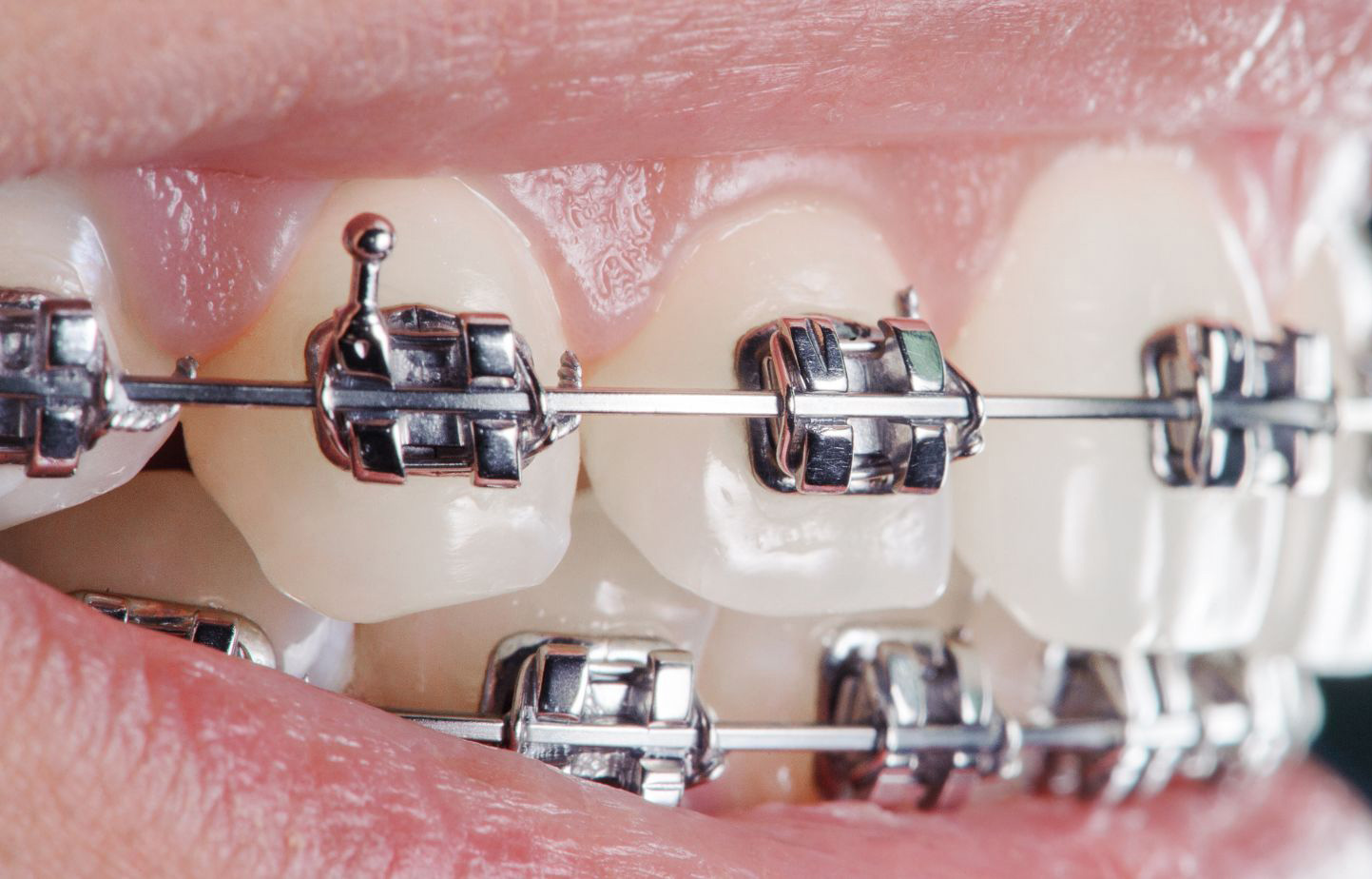 Shape memory alloy wire medical